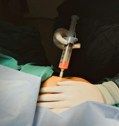 تجمع السوائل بعد شفط الدهون: أسبابه وطرق العلاج الفعالة